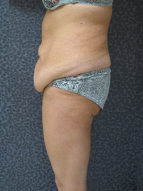 Avant Abdominoplastie - Patiente 1 de profile