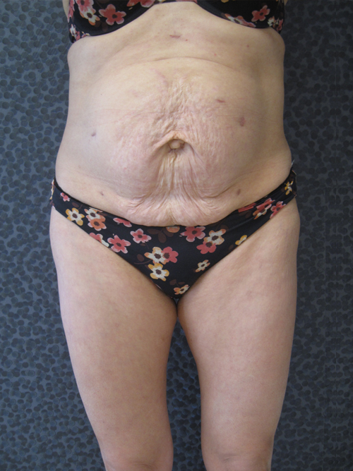 Avant Abdominoplastie - Patiente 8 de face