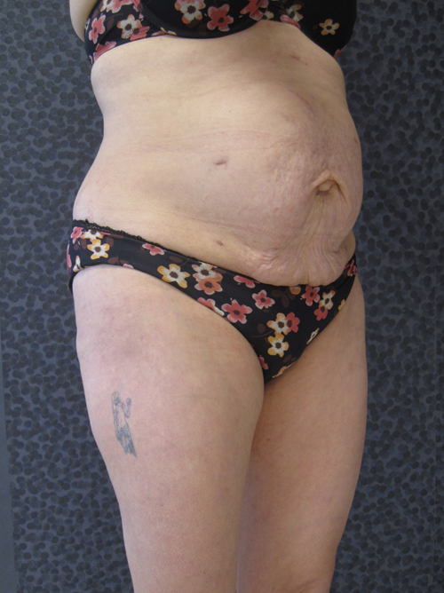 Avant Abdominoplastie - Patiente 8 de profile