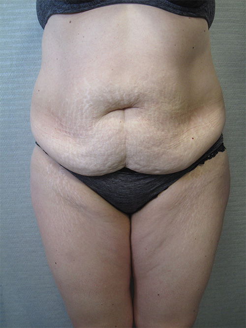 Avant Abdominoplastie - Patiente 1 de face