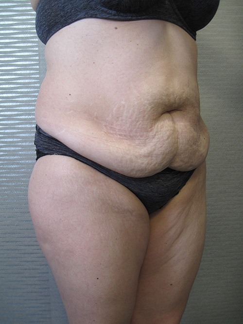 Avant Abdominoplastie - Patiente 1 de profile