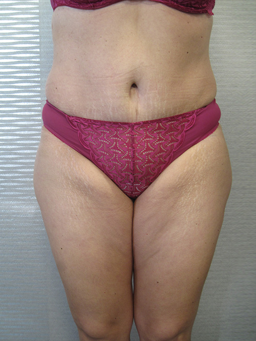 Après Abdominoplastie - Patiente 1 de face