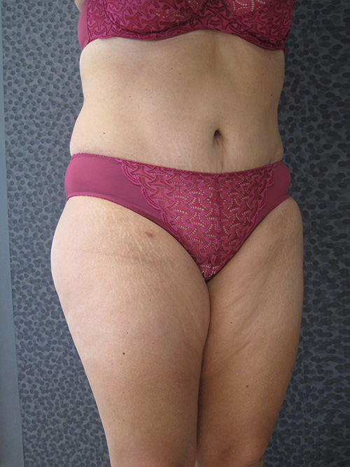 Après Abdominoplastie - Patiente 1 de profile