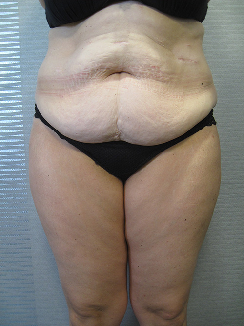 Avant Abdominoplastie - Patiente 2 de face