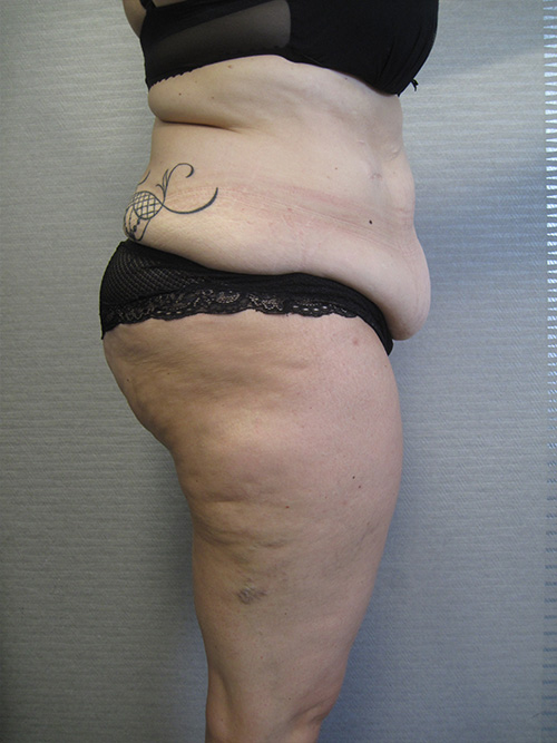 Avant Abdominoplastie - Patiente 2 de profile