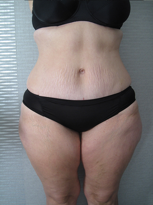 Après Abdominoplastie - Patiente 3 de face