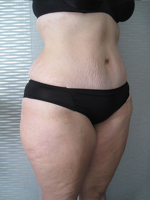 Après Abdominoplastie - Patiente 3 de profile