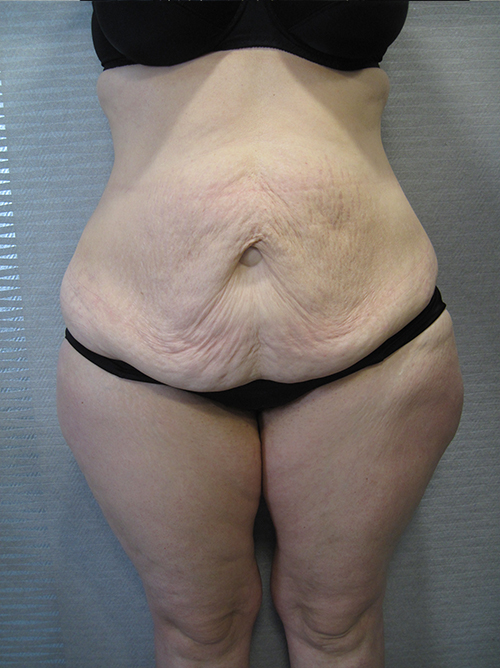 Avant Abdominoplastie - Patiente 3 de face