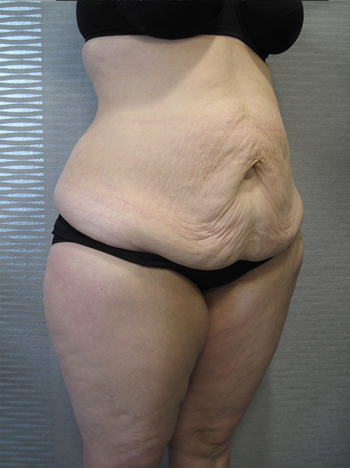 Avant Abdominoplastie - Patiente 3 de profile