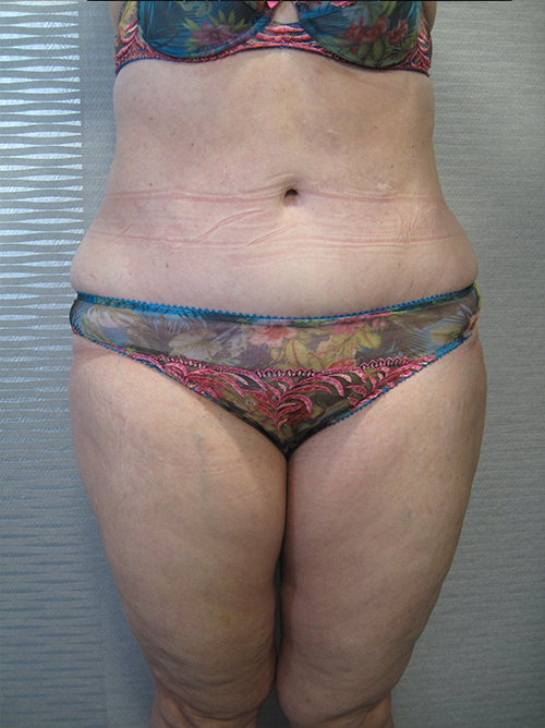 Après Abdominoplastie - Patiente 4 de face