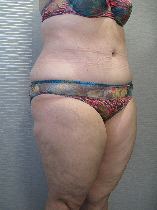 Après Abdominoplastie - Patiente 4 de profile