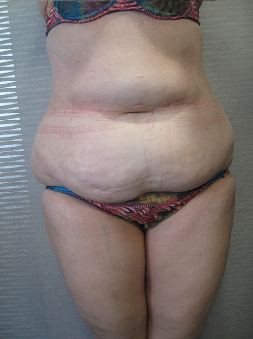 Avant Abdominoplastie - Patiente 4 de face