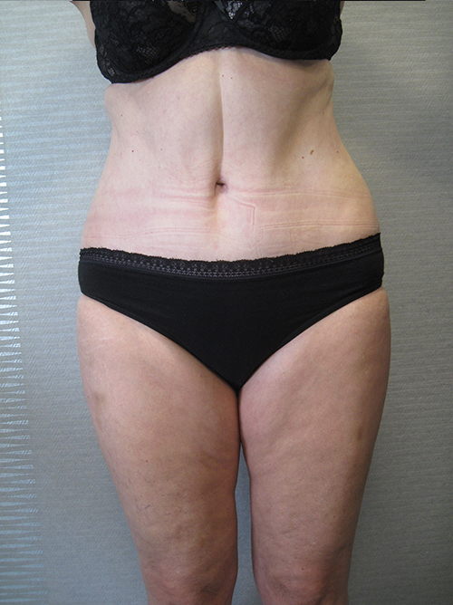 Après Abdominoplastie - Patiente 5 de face