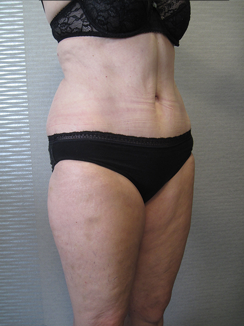 Après Abdominoplastie - Patiente 5 de profile