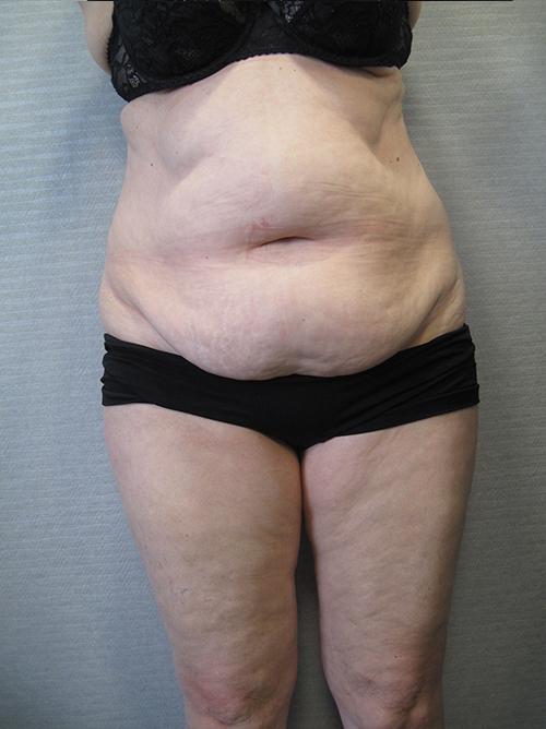 Avant Abdominoplastie - Patiente 5 de face