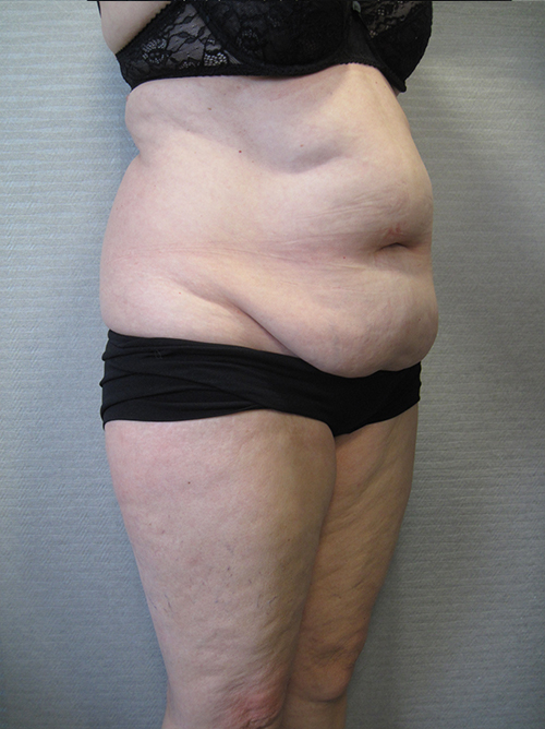 Avant Abdominoplastie - Patiente 5 de profile