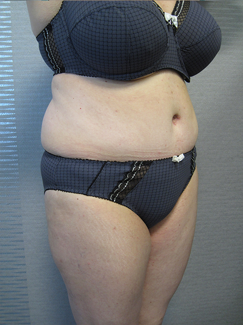 Après Abdominoplastie - Patiente 6 de profile