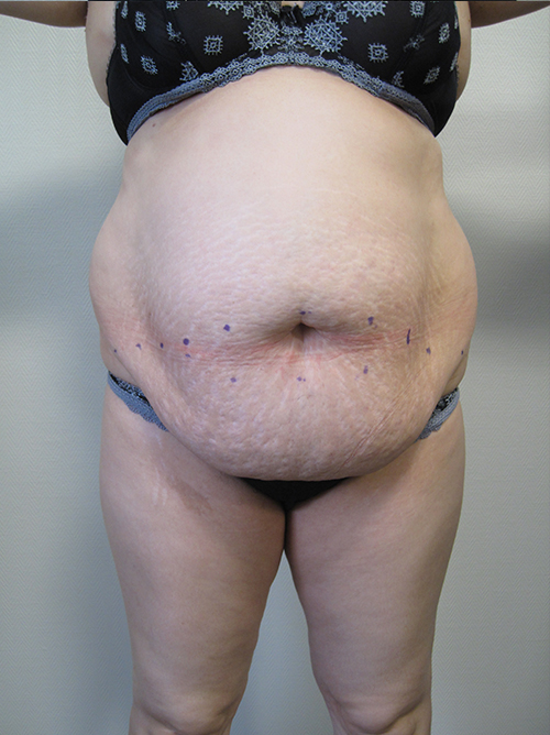 Avant Abdominoplastie - Patiente 7 de face