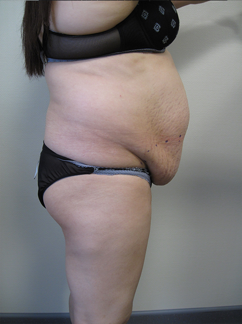 Avant Abdominoplastie - Patiente 7 de profile