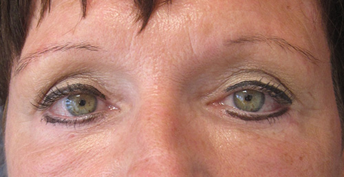 Après Blepharoplastie - Patiente 2