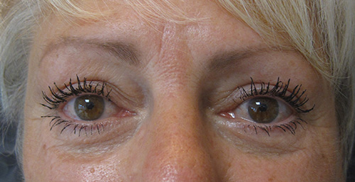 Après Blepharoplastie - Patiente 2