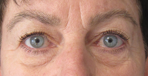 Avant Blepharoplastie - Patiente 2