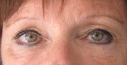 Avant Blepharoplastie - Patiente 2