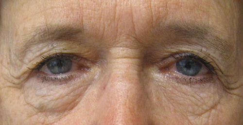 Avant Blepharoplastie - Patiente 2