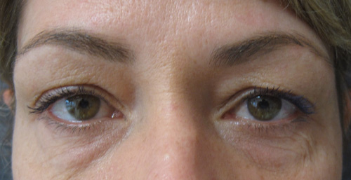 Avant Blepharoplastie - Patiente 2