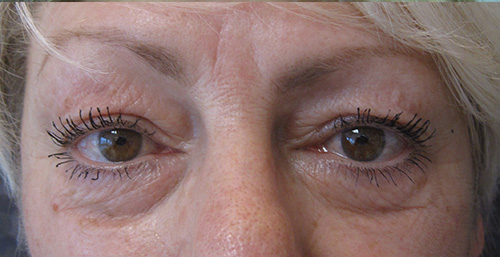 Avant Blepharoplastie - Patiente 2