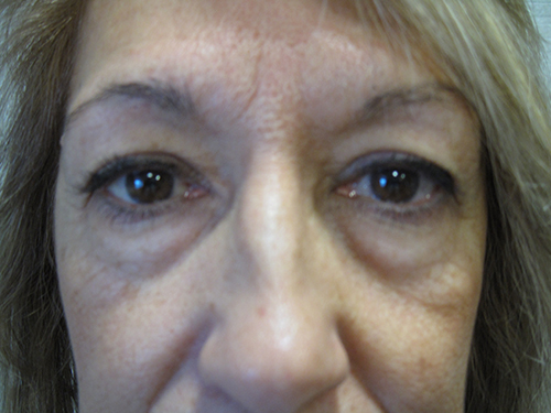 Avant Blepharoplastie - Patiente 8