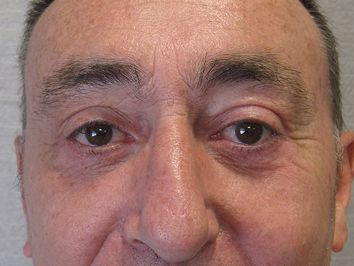 Après Blepharoplastie - Patient 10