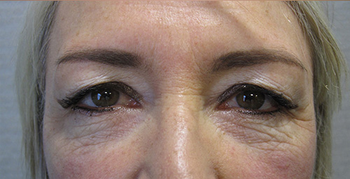 Avant Blepharoplastie - Patiente 2