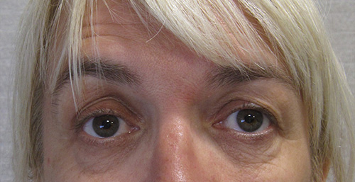 Avant Blepharoplastie - Patiente 4