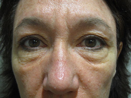 Avant Blepharoplastie - Patiente 6