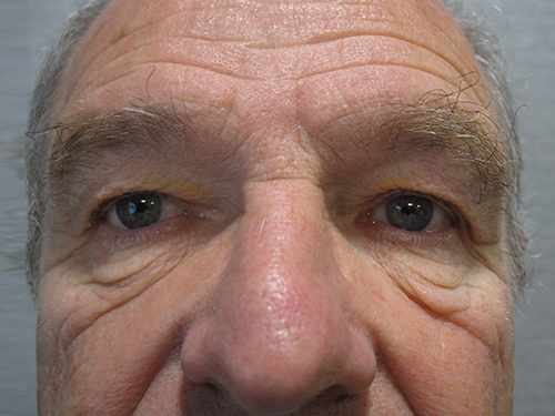 Avant Blepharoplastie - Patient 9