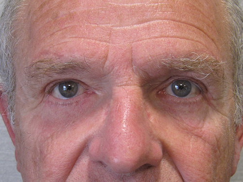 Après Blepharoplastie - Patient 9