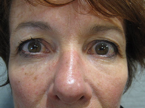 Avant Blepharoplastie - Patiente 7