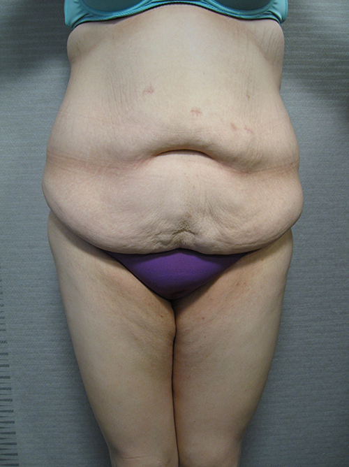 Avant Bodylift - Patiente 1 de face