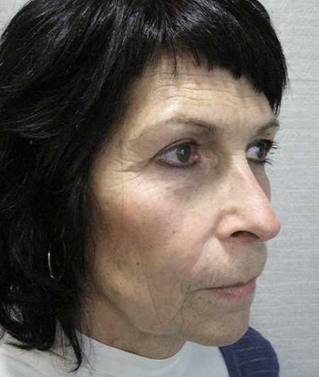 Avant Lifting Cervico-facial - Patiente 1