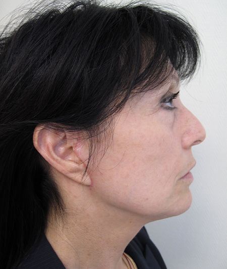 Après Lifting Cervico-facial - Patiente 2