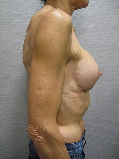 Après Prothèses Mammaires - Patiente 2 de profile