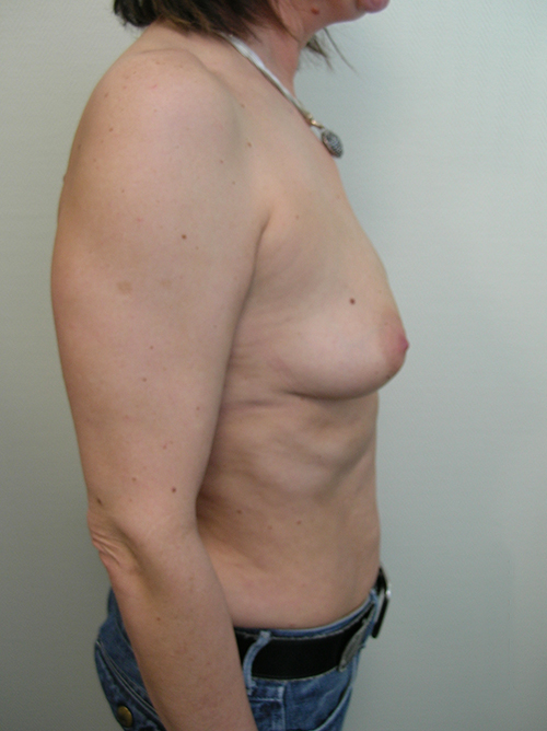 Avant Prothèses Mammaires - Patiente 3 de profile