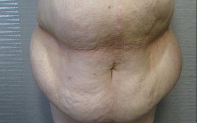 Patiente 1 - Abdominoplastie avant