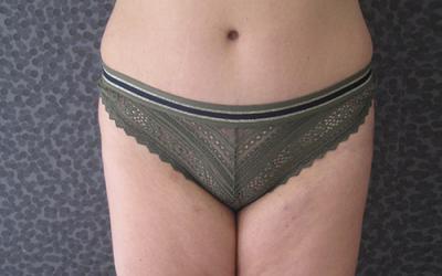 Patiente 1 - Abdominoplastie après