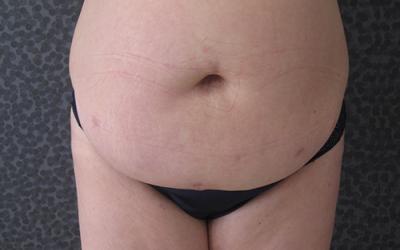 Patiente 1 - Abdominoplastie avant