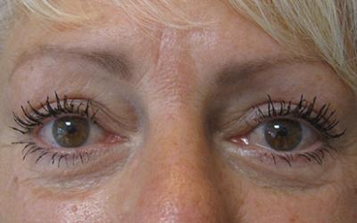 Patiente 1 - blepharoplastie après