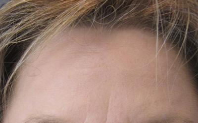 Patiente 1 - Botox après