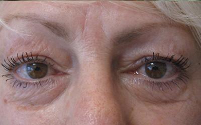 Patiente 1 - blepharoplastie avant