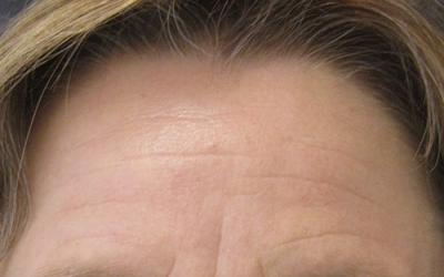 Patiente 1 - Botox avant